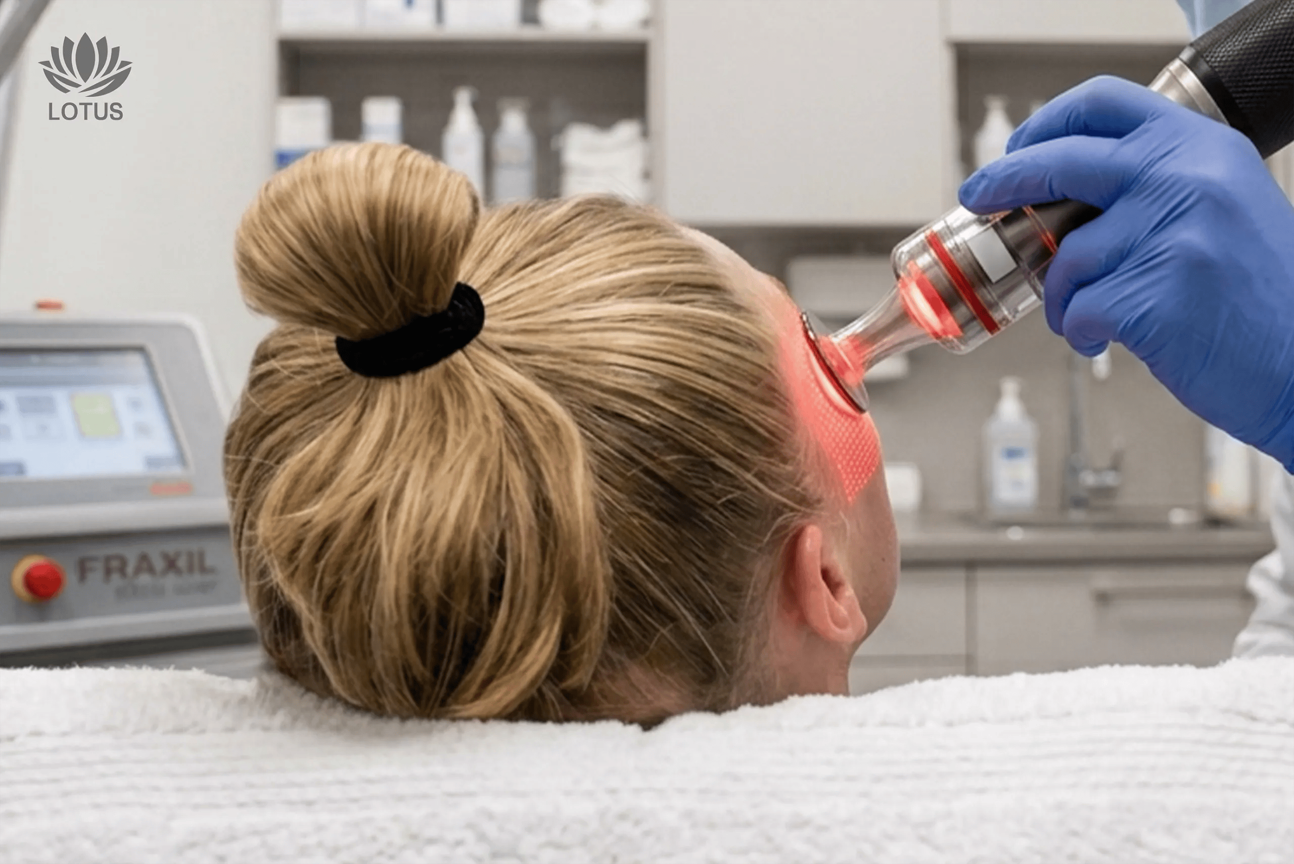 Láser CO2 Fraccionado en San Leandro | Renovación Facial // Fractional CO2 Laser in San Leandro | Facial Renewal