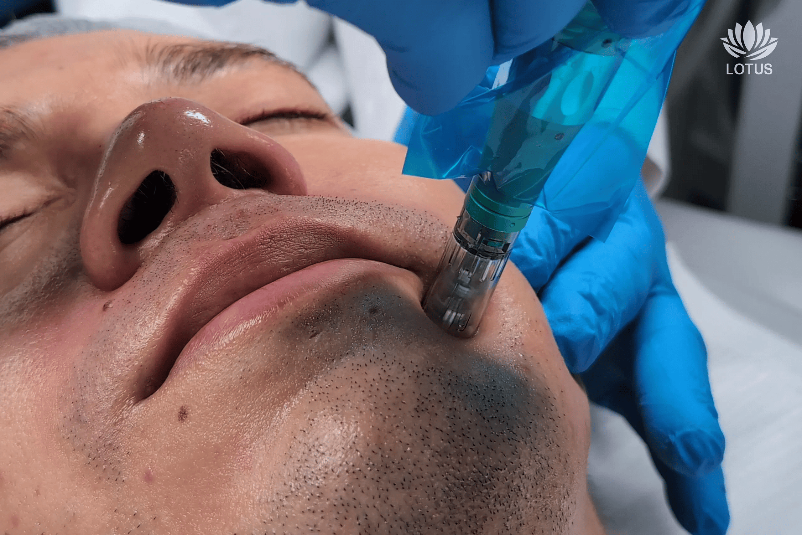 Microneedling con PDRN en San Leandro | Regeneración Facial // Microneedling with PDRN in San Leandro | Skin Regeneration