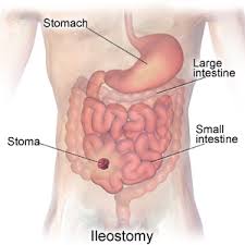 ileostomy