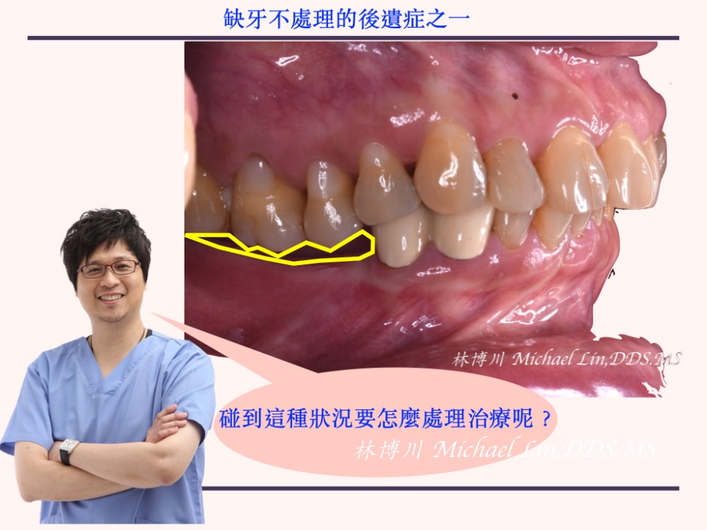 缺牙不處理的後遺症之一