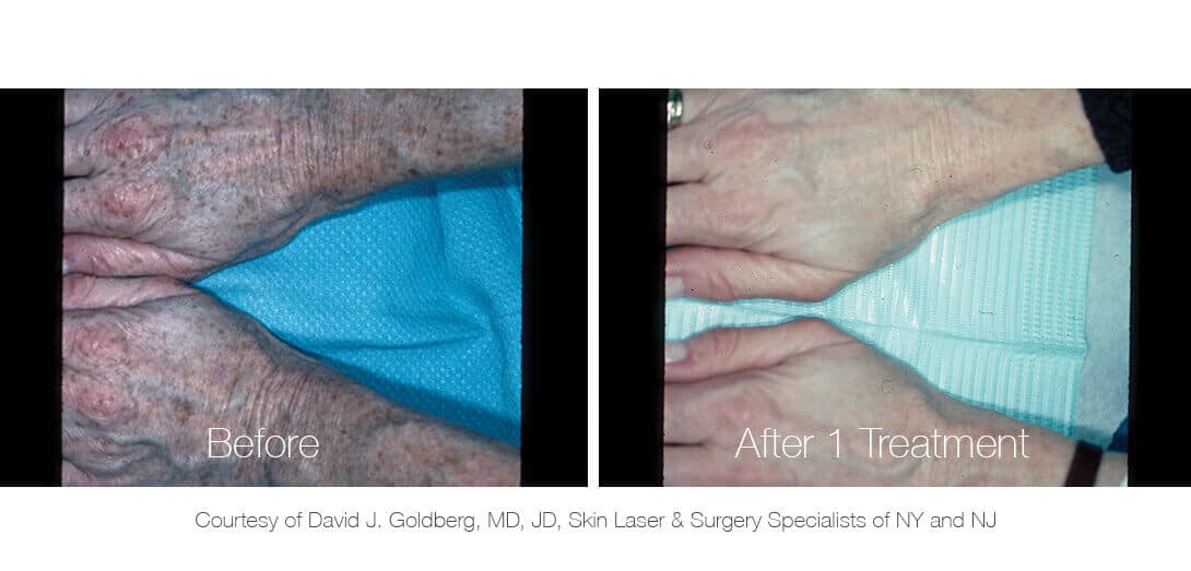 Soprano ice features alma's unique alex tm technology which combines the high absorption benefits of the alexandrite 755nm wavelength with the treatment coverage, comfort and low maintenance of the diode laser. Nd:YAG Laser Tattoo & Pigmentation Removal Machine - PiQo4 | Lumenis