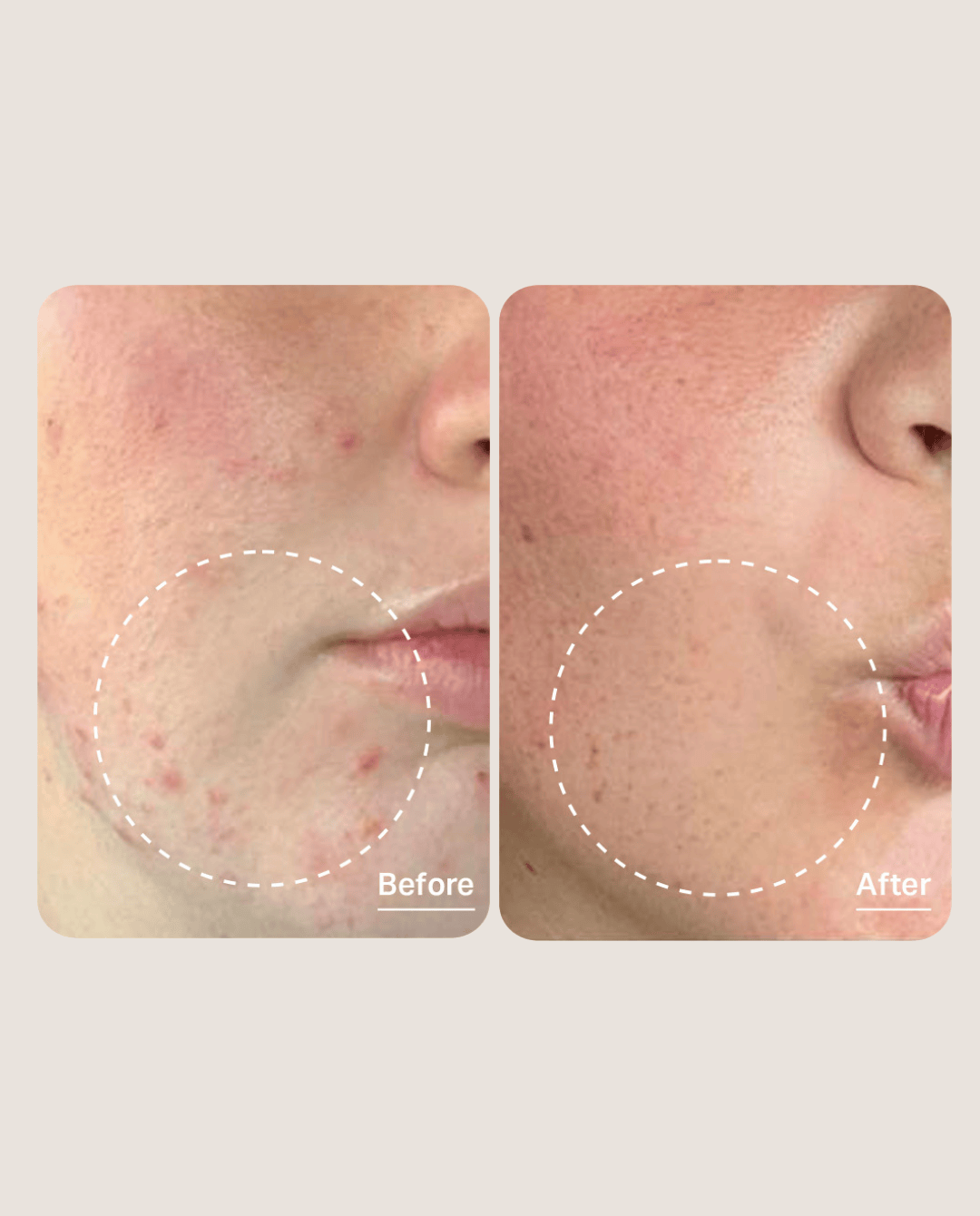 hydrafacial before & after 1