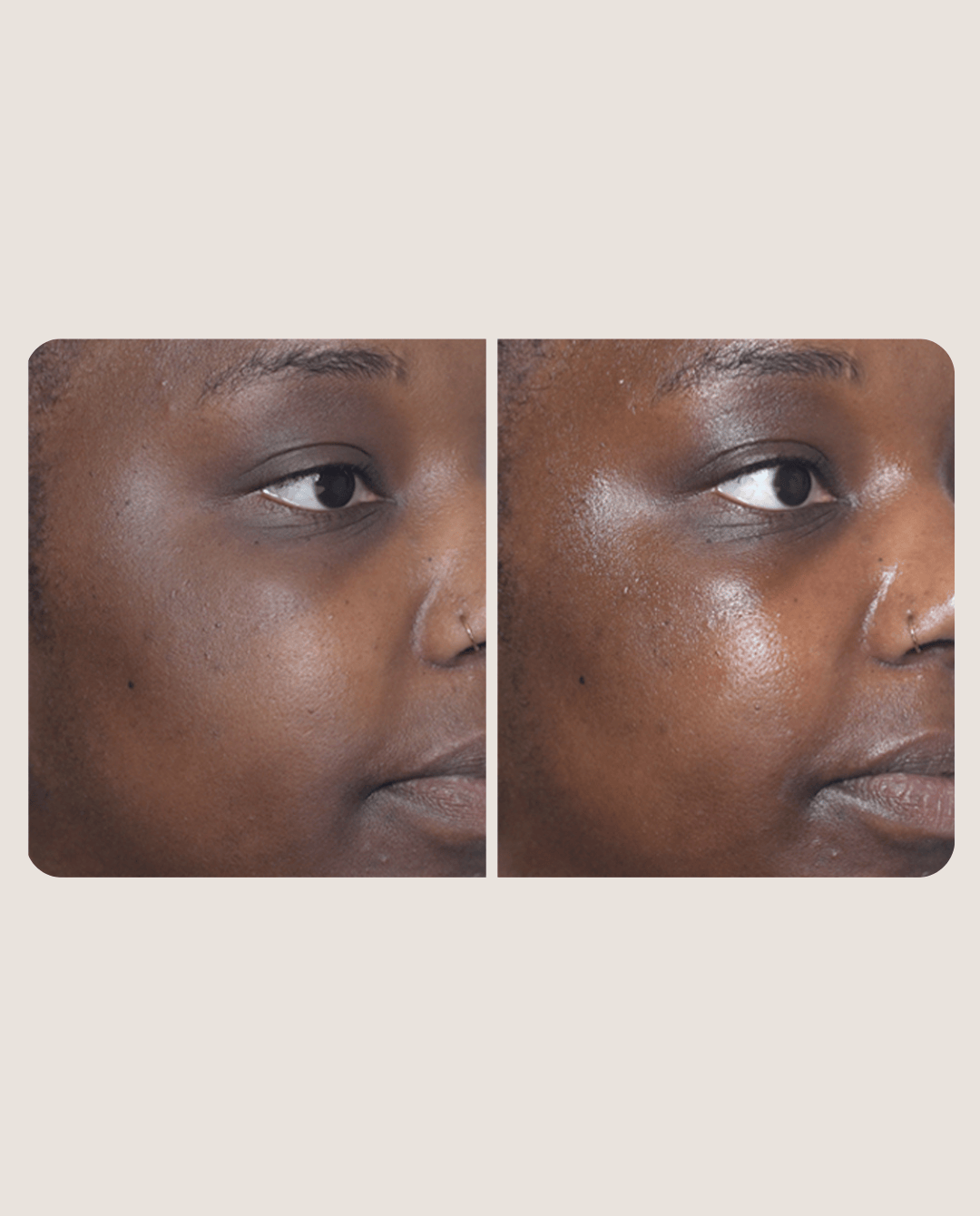 hydrafacial before & after 2