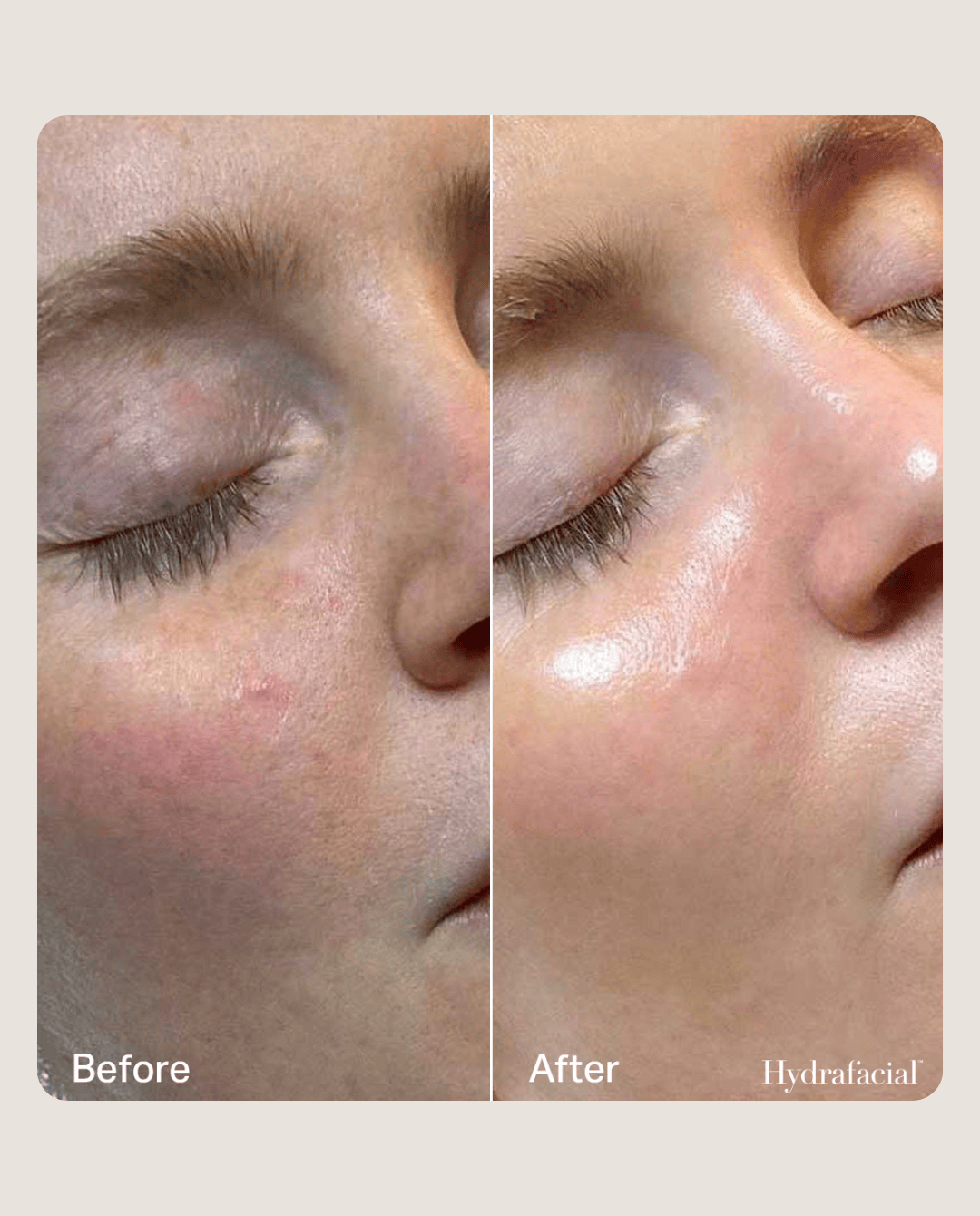 hydrafacial before & after 3