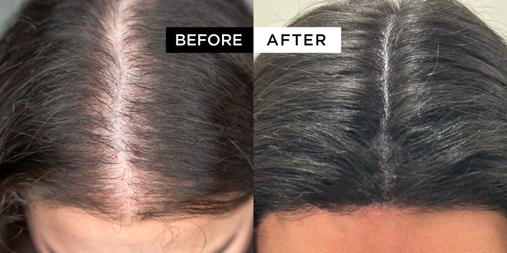 micropigmentation