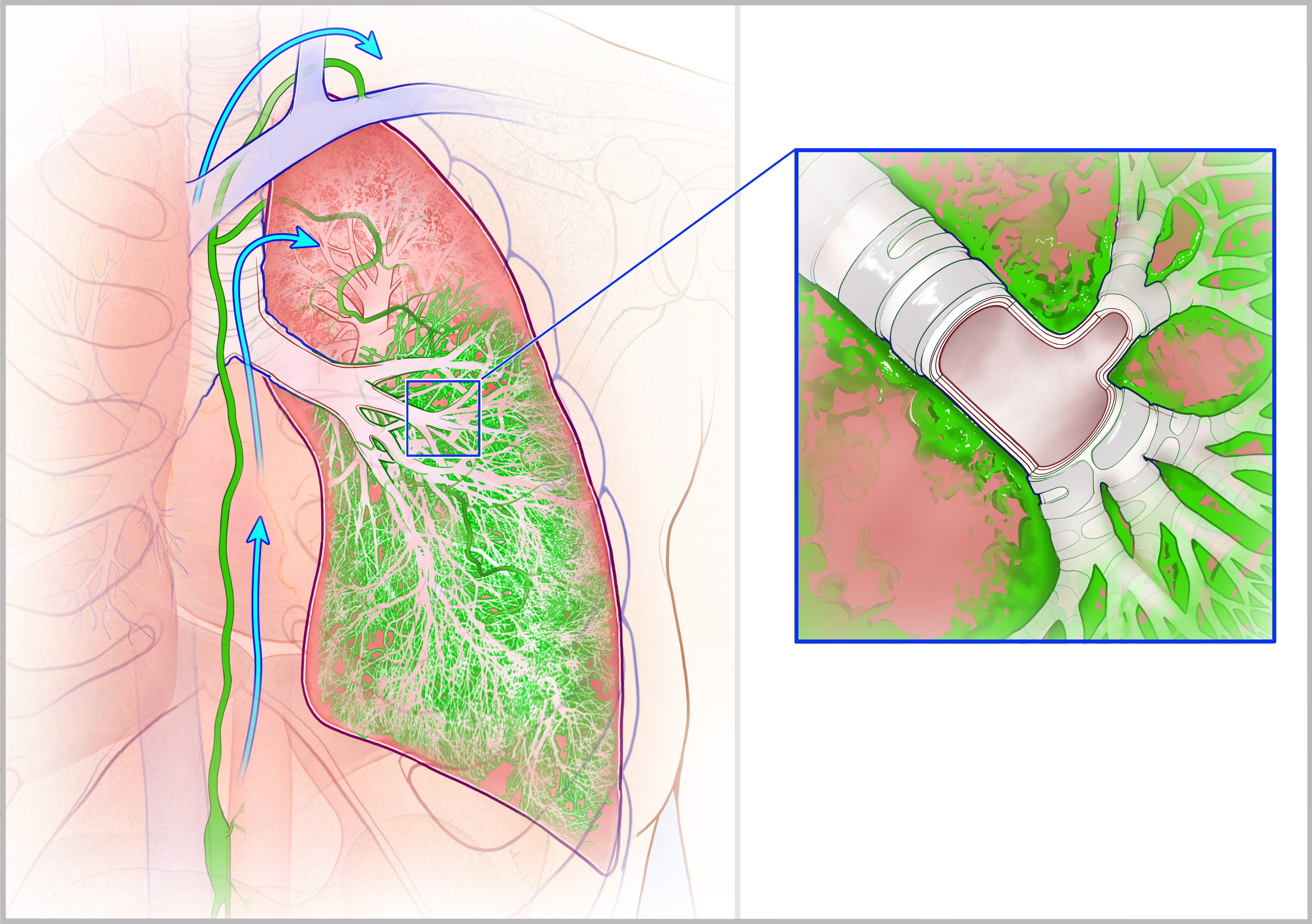 Lymphatic Disorders – Dr. Maxim Itkin, Interventional Radiology