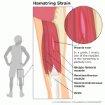 Hamstring