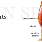 Shin splint