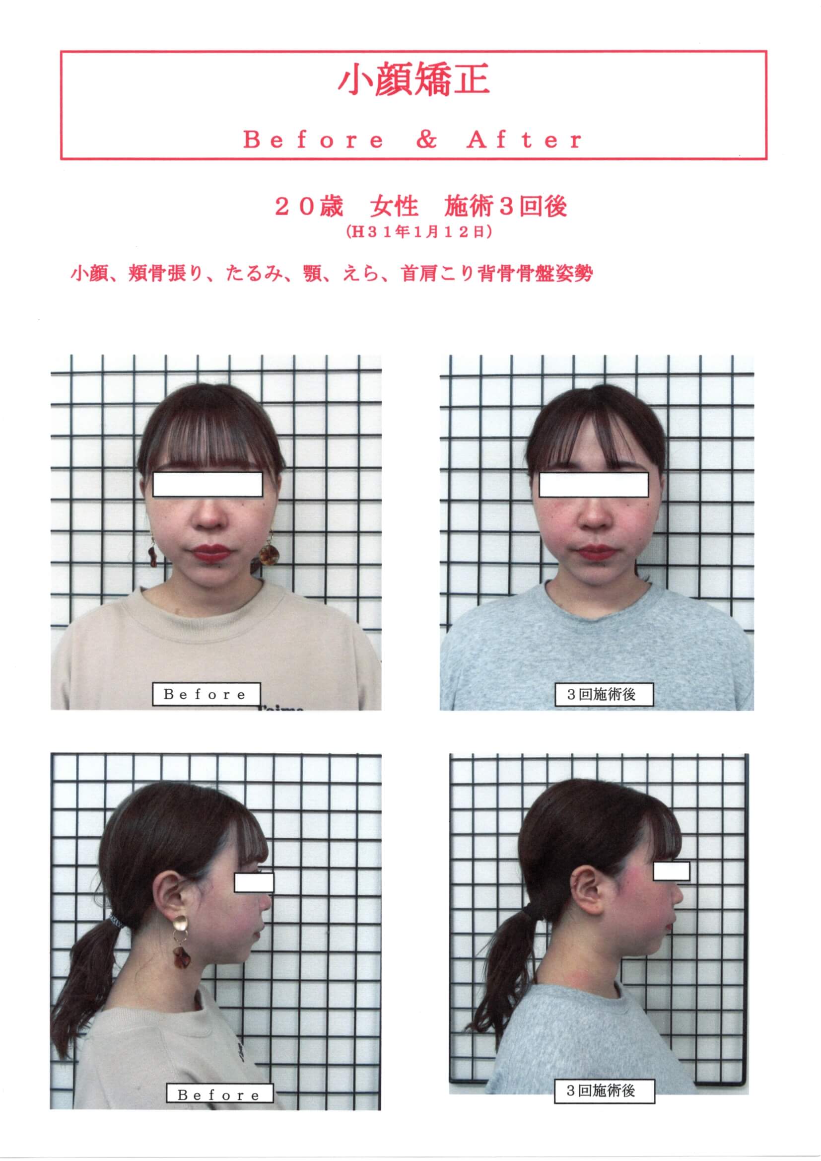 高知 小顔矯正 戻りにくい高知で人気の小顔矯正！！貴女も小顔美人に