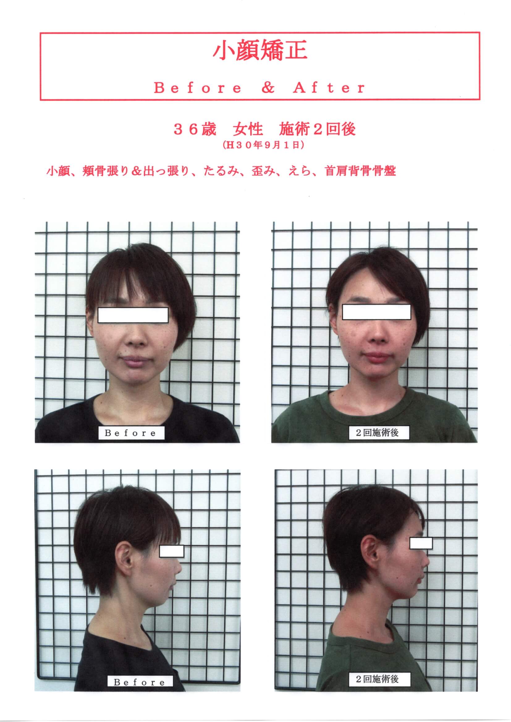 口コミが実証！！小顔矯正""