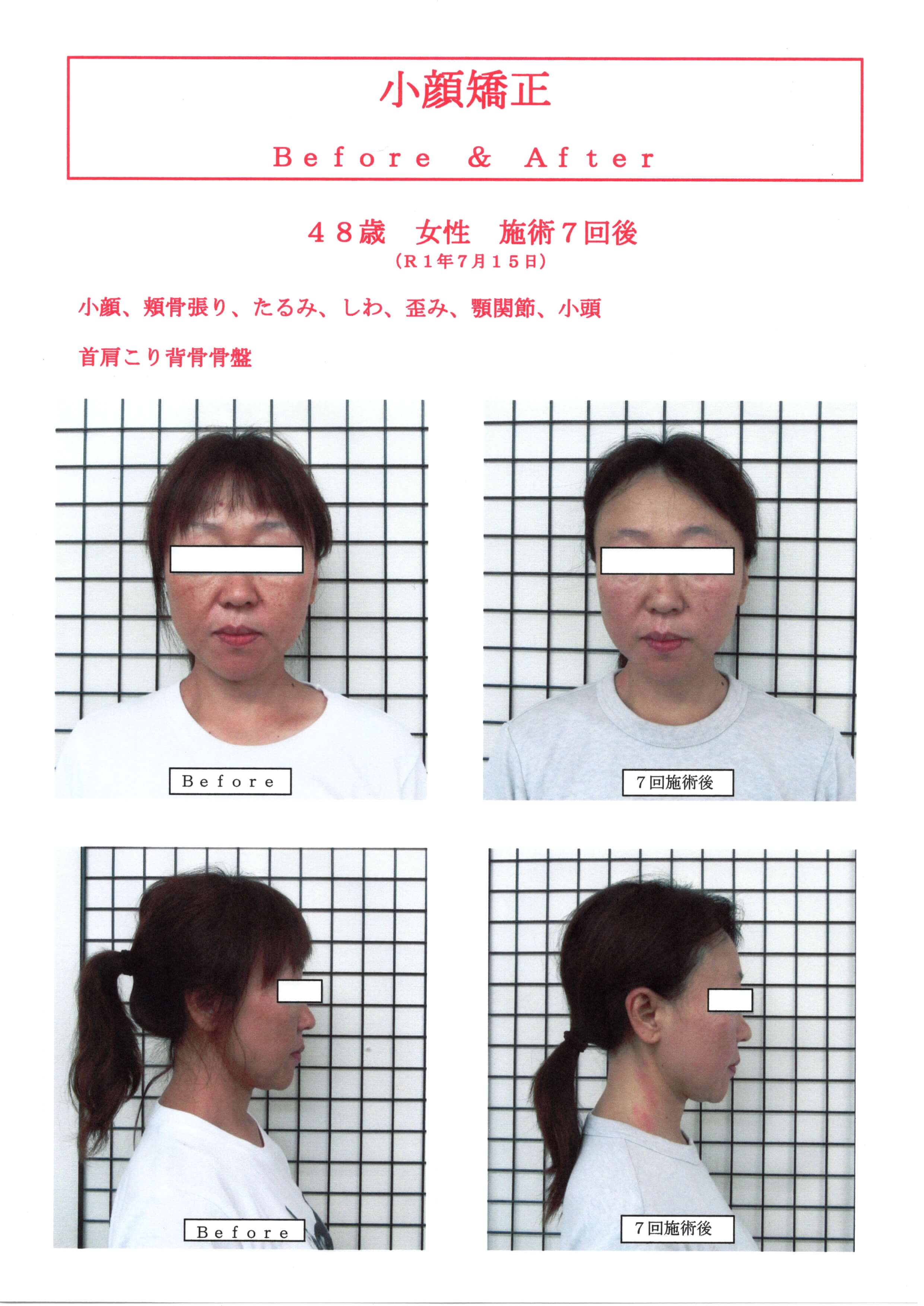 ４８歳女性小顔矯正＆骨盤矯正