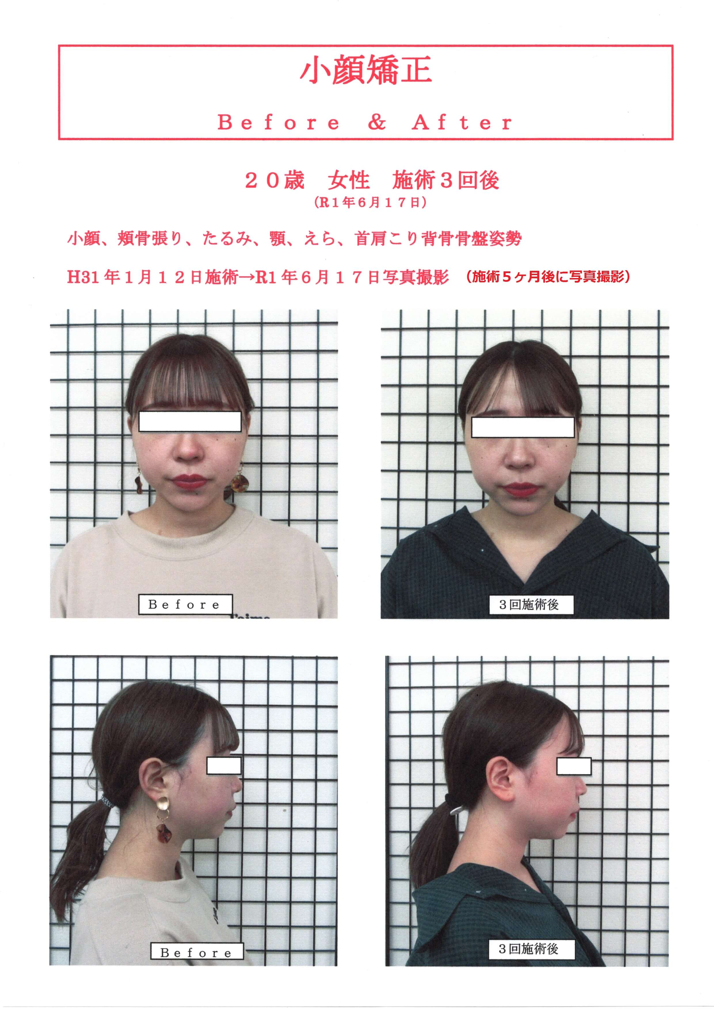 貴女も小顔美人に！高知で人気の小顔矯正