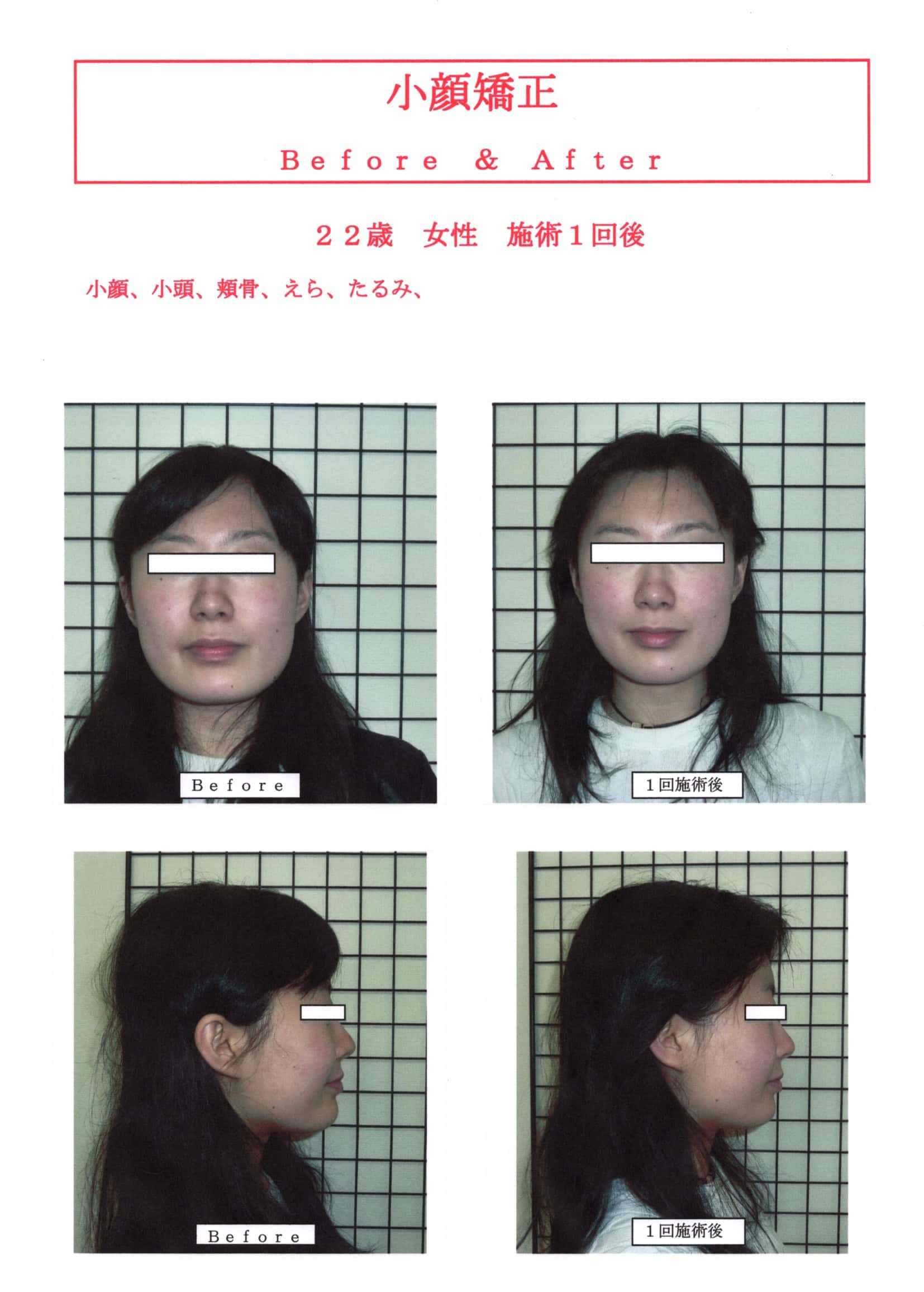 高知 小顔矯正 戻りにくい小顔矯正効果高知 | 小顔矯正なら前田整体院
小顔矯正SP１回施術後のBefore＆After