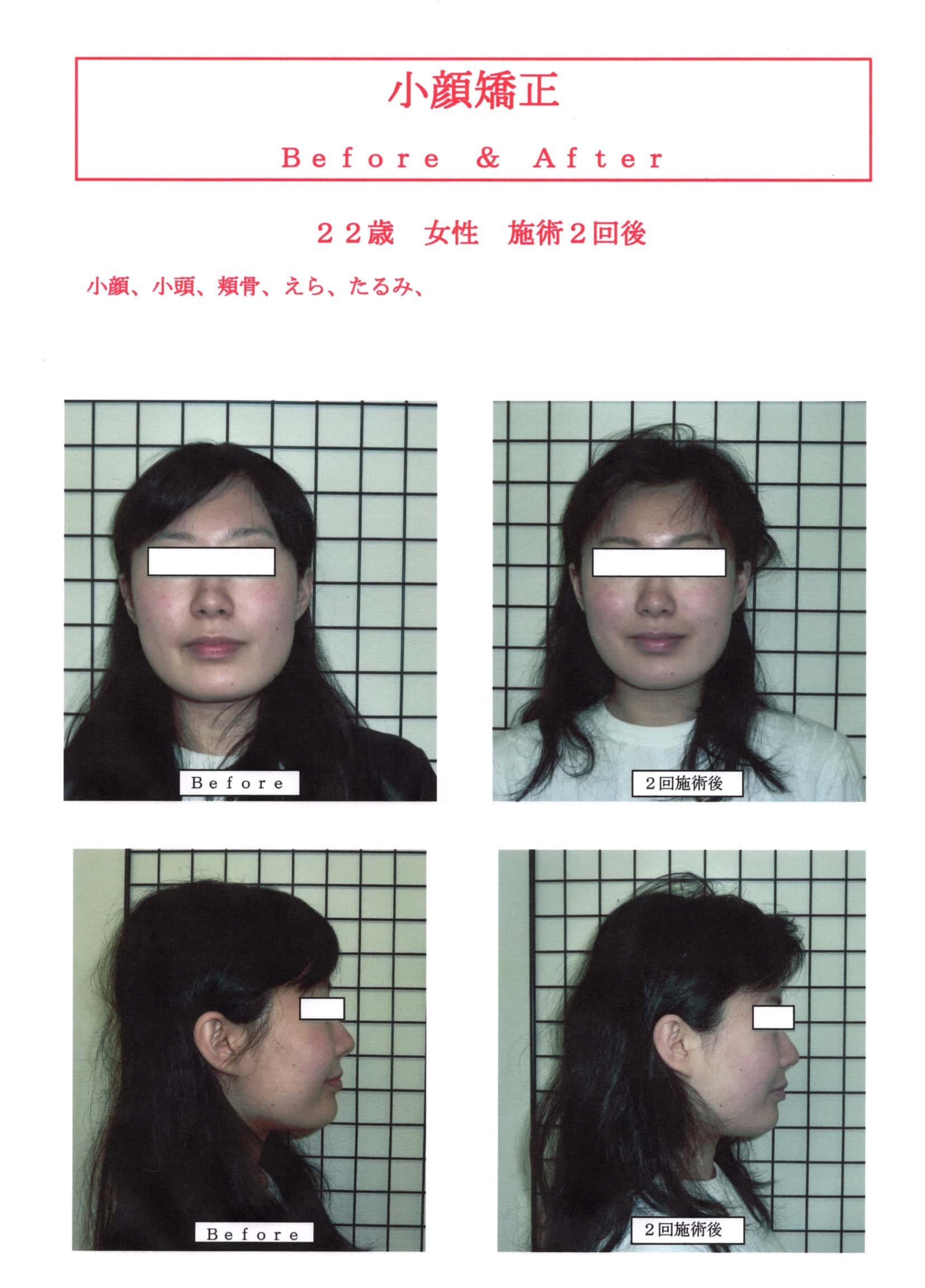 小顔矯正効果高知 | 小顔矯正なら前田整体院
小顔矯正SP2回施術後のBefore＆After