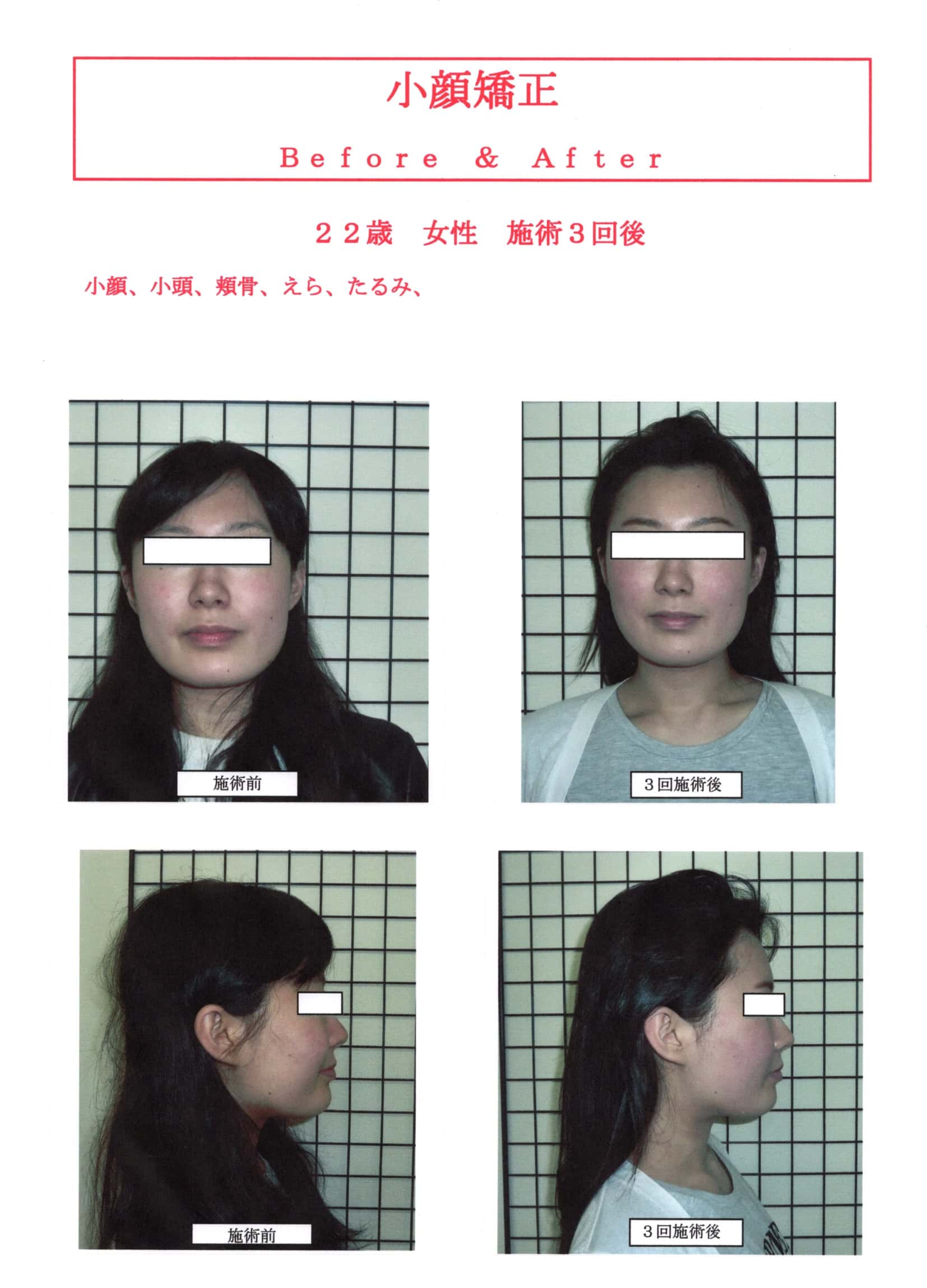 小顔矯正効果高知 | 小顔矯正なら前田整体院
小顔矯正SP3回施術後のBefore＆After