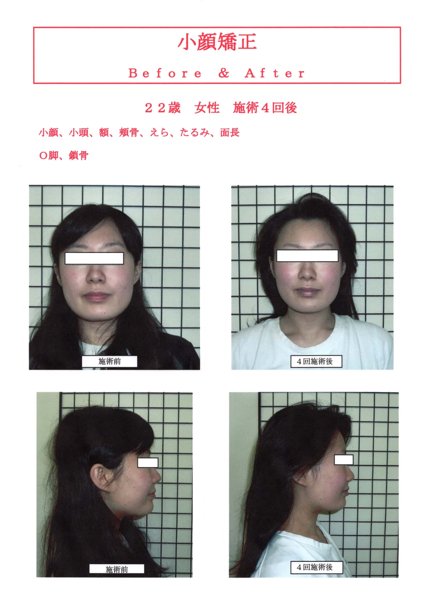 小顔矯正効果高知 | 小顔矯正なら前田整体院
小顔矯正SP4回施術後のBefore＆After