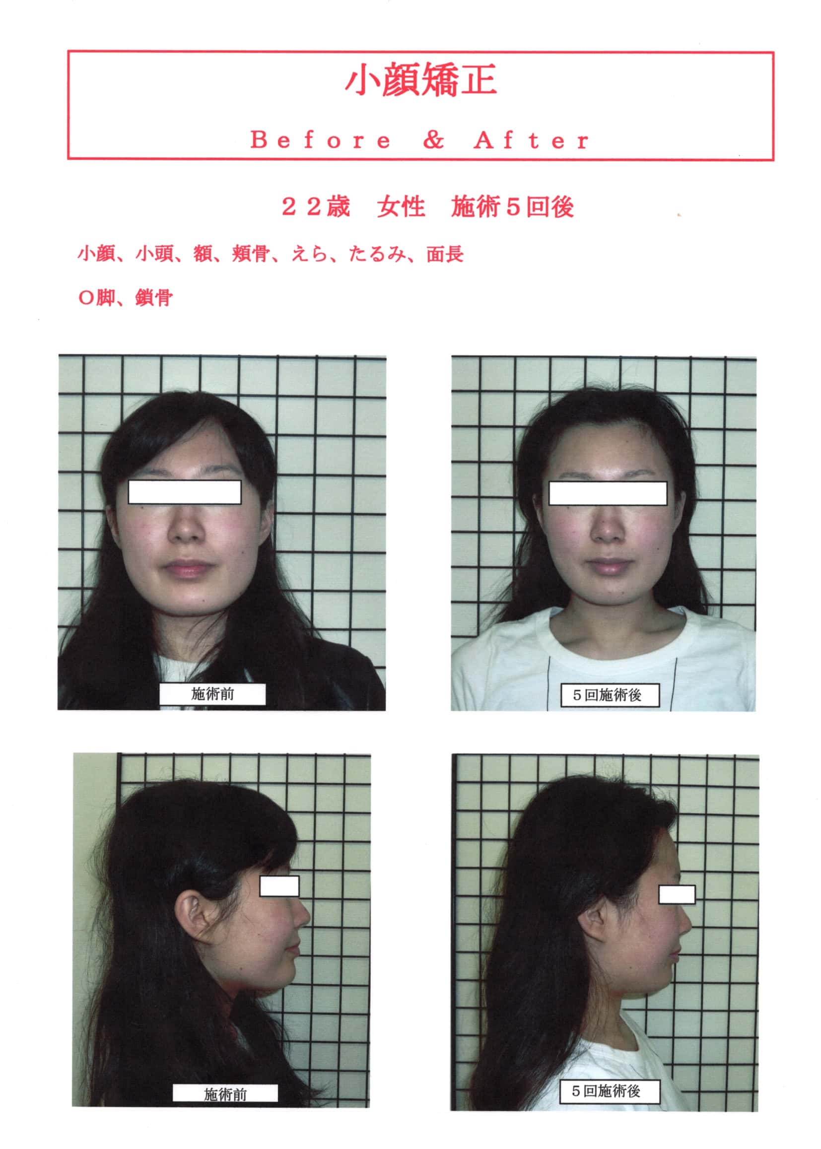 小顔矯正効果高知 | 小顔矯正なら前田整体院
小顔矯正SP5回施術後のBefore&After