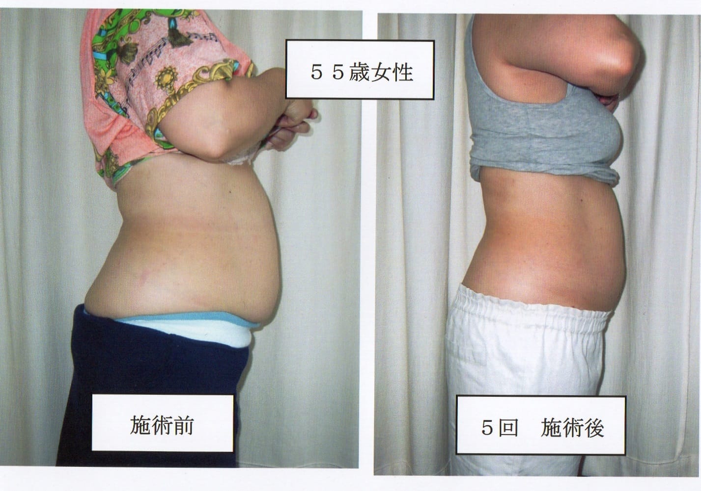 ボディスリムダイエット５５歳女性５回施術後のBefore＆After