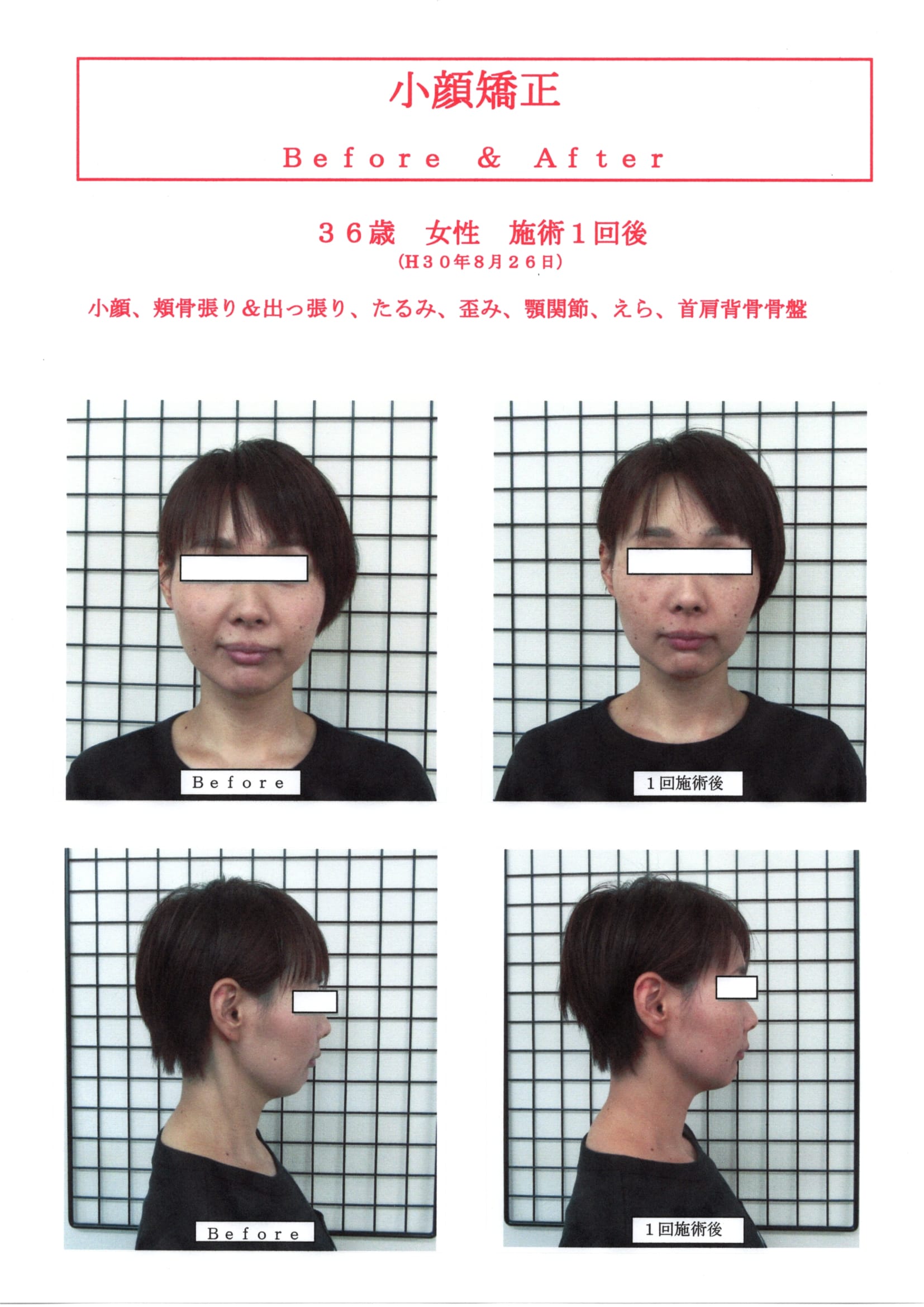 高知 小顔矯正 戻りにくい小顔矯正３６歳女性１回施術後のBefore＆After