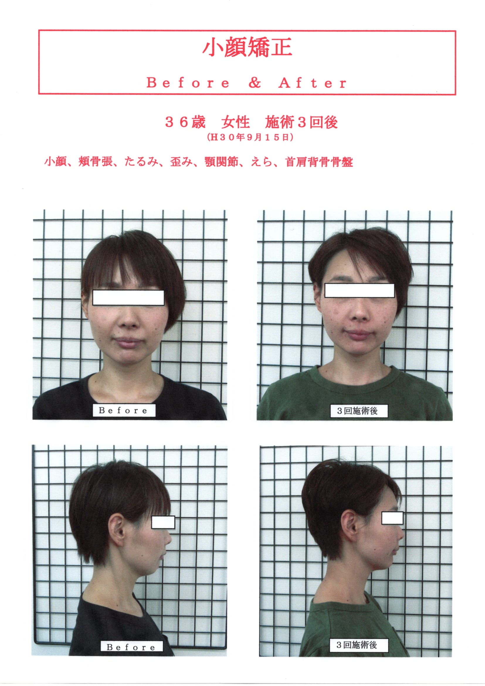 小顔矯正３６歳女性３回施術後のBefore＆After