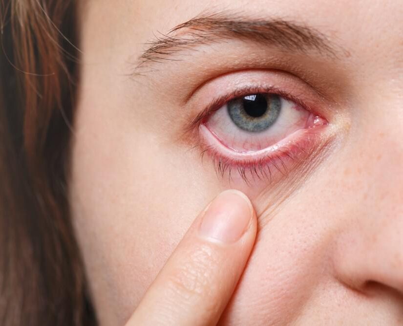 Eye Infections