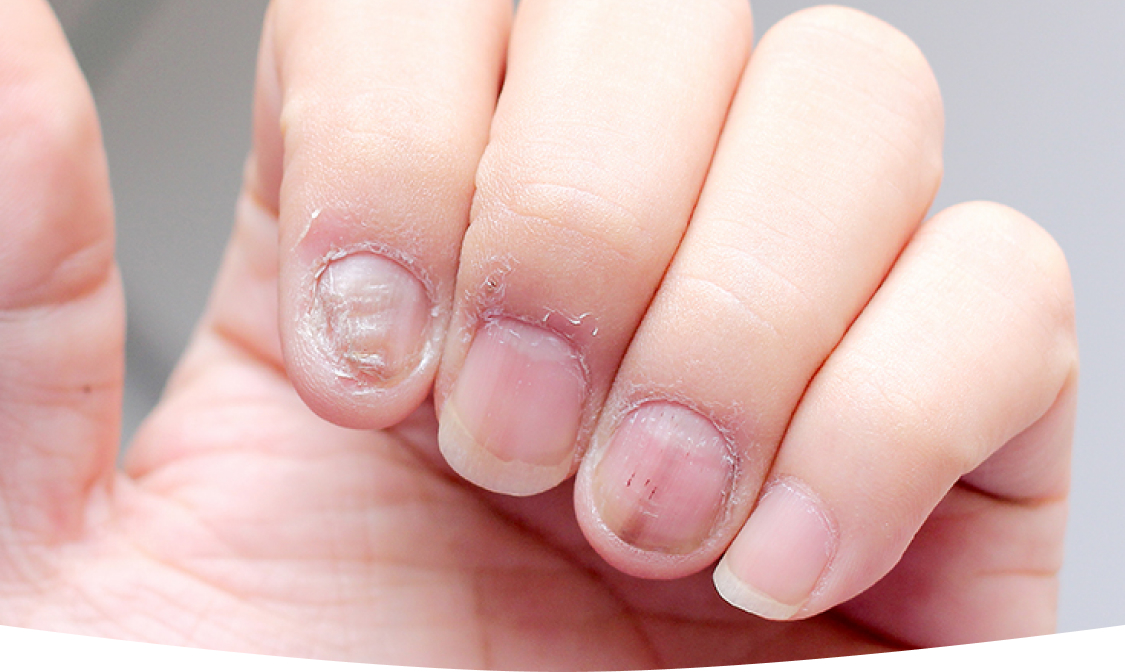 How Fungal Nail Treatments Can Restore Your Confidence