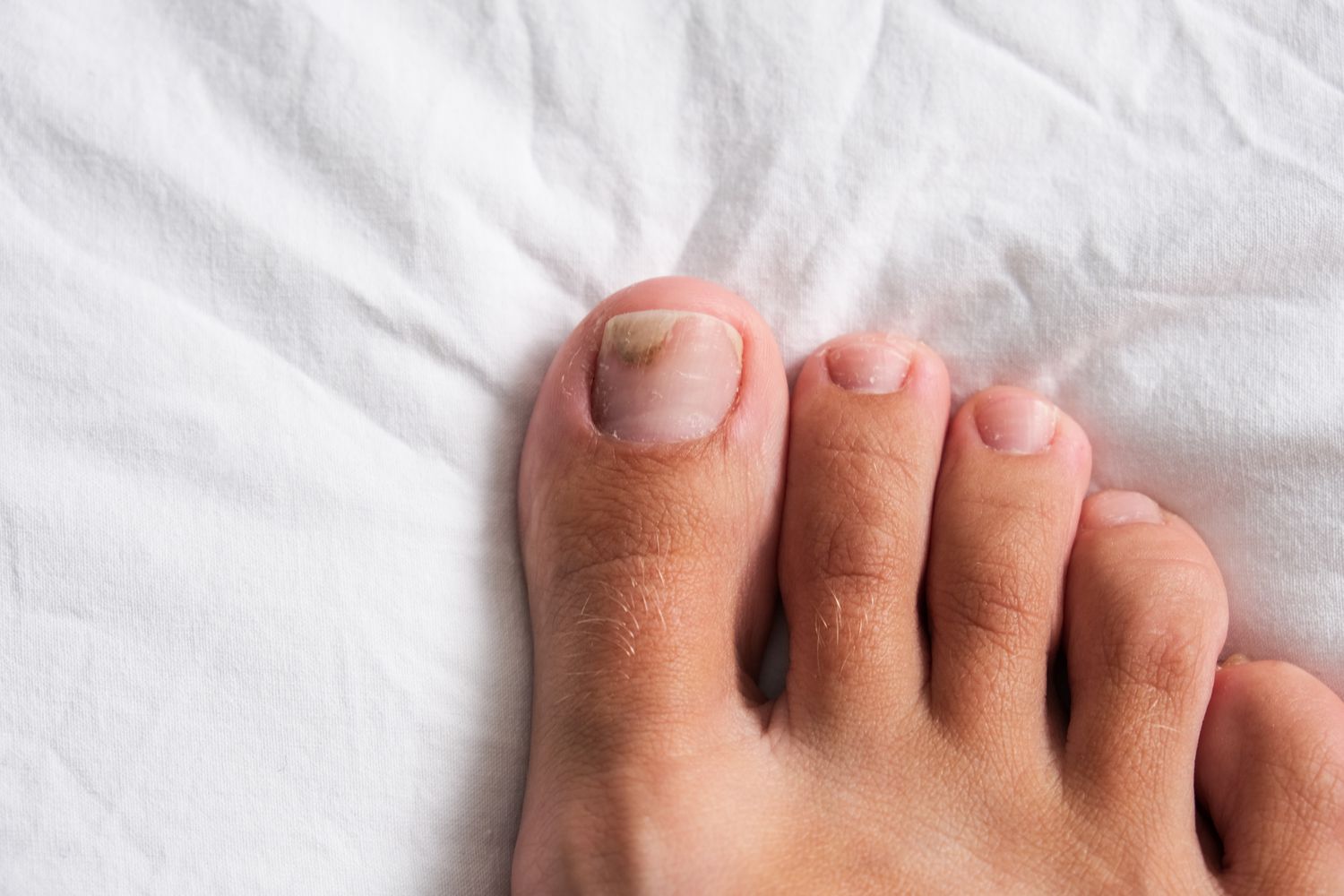 Combat Fungal Nail Infections with Expert Laser Treatments in London