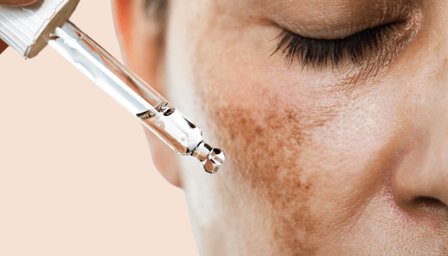 Chemical Peels for Hyperpigmentation: A Comprehensive Guide