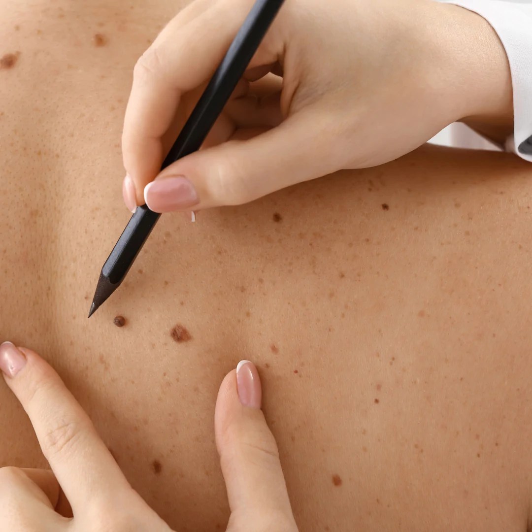 Dermatology Examination:::A close-up of a healthcare professional's hand examining a patient's moles on their skin with a black dermoscopy pen.