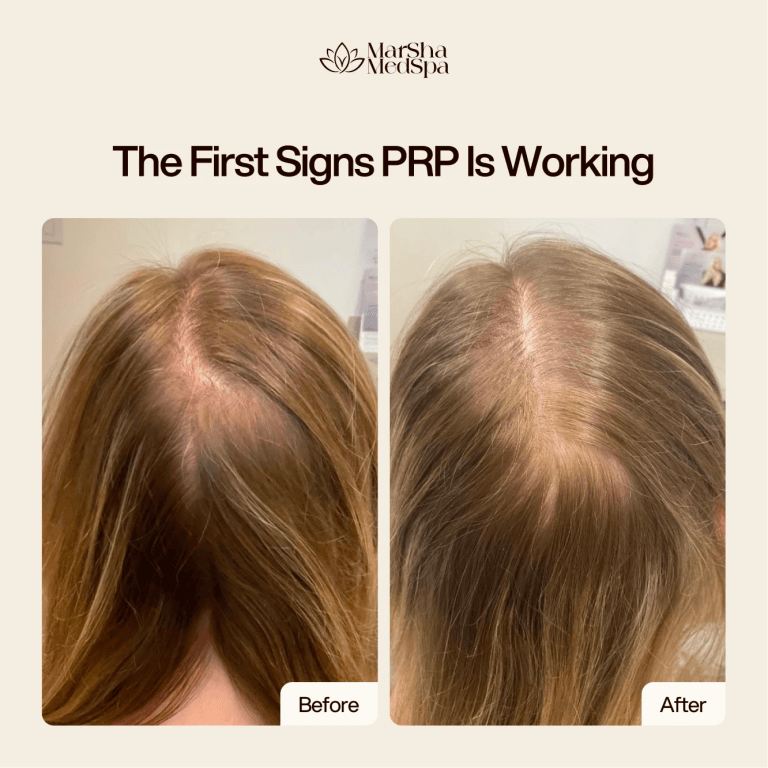 How long does PRP take to work