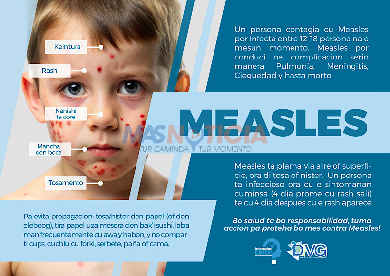 Con Measles (sarampi) ta transmiti su mes