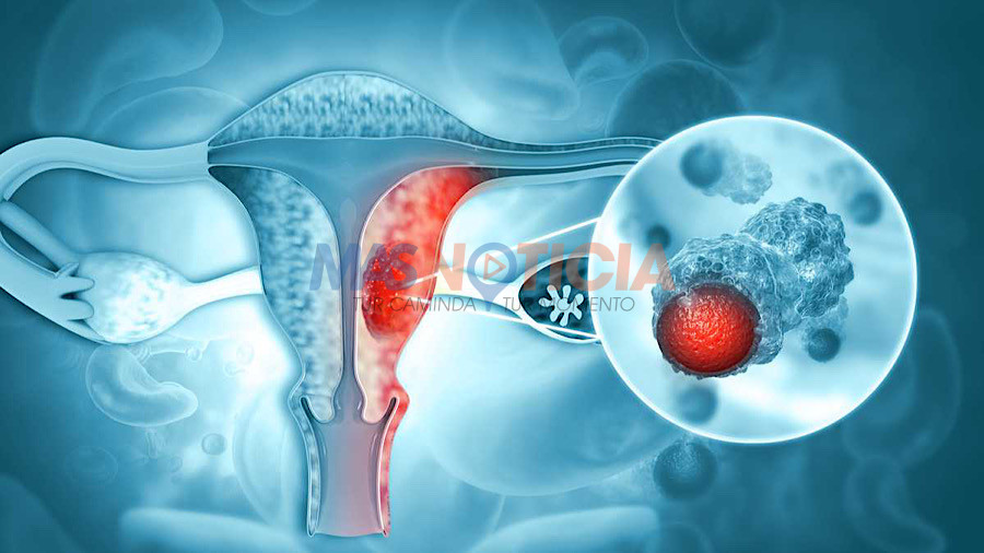 Luna di Concientisacion di Cancer na Boca di Matriz
