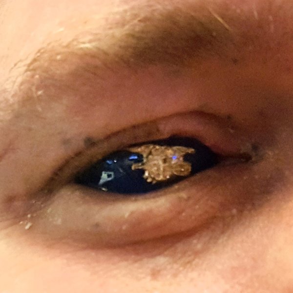 Crenshaw Eye Injury This Shocking Insight Changed Everything And Could Save Your Sight - q4kzphs