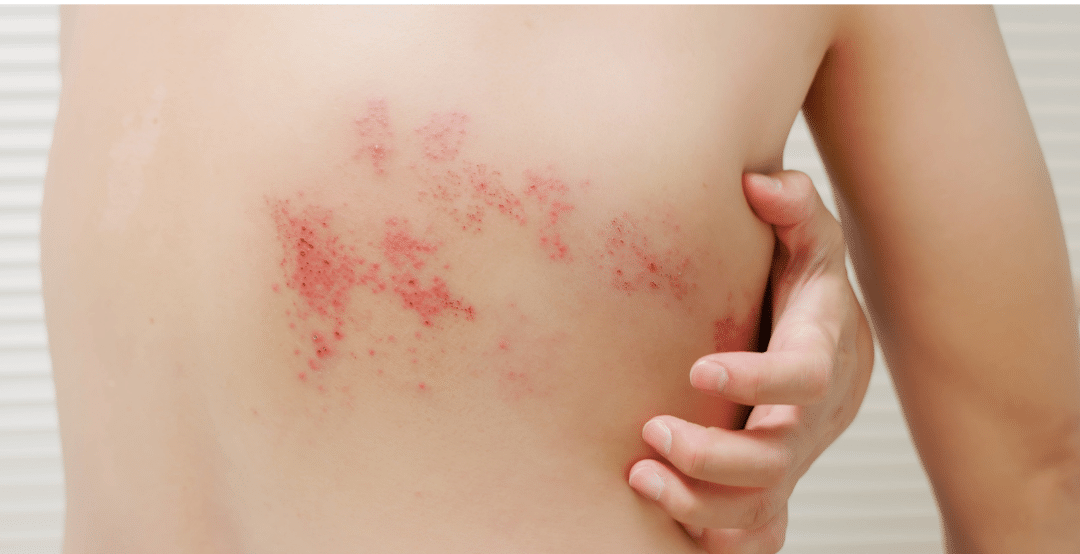 shingles