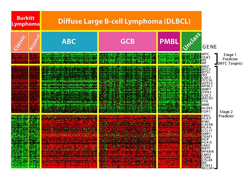 A DNA-microarray analysis of Burkitt's lymphoma and Diffuse Large B-cell Lymphoma