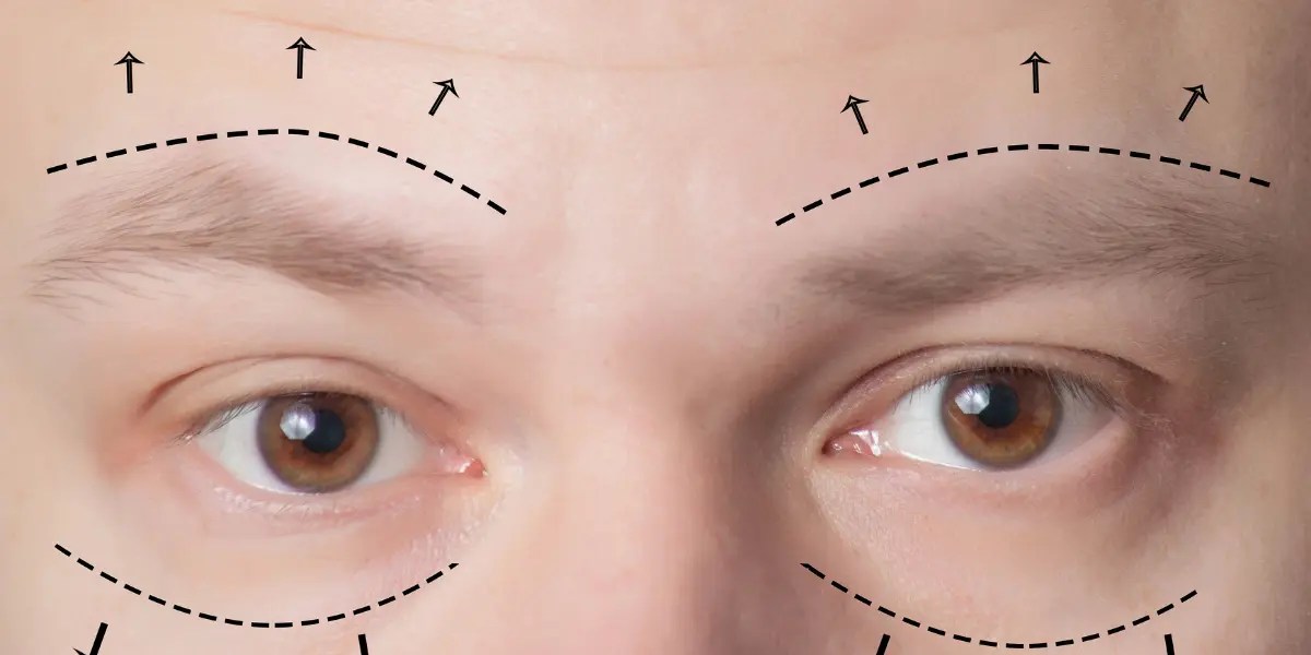 lower blepharoplasty