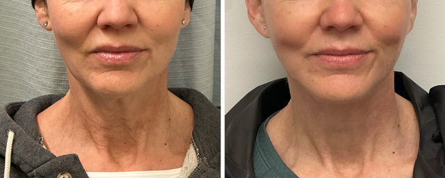 Facelift Before and After