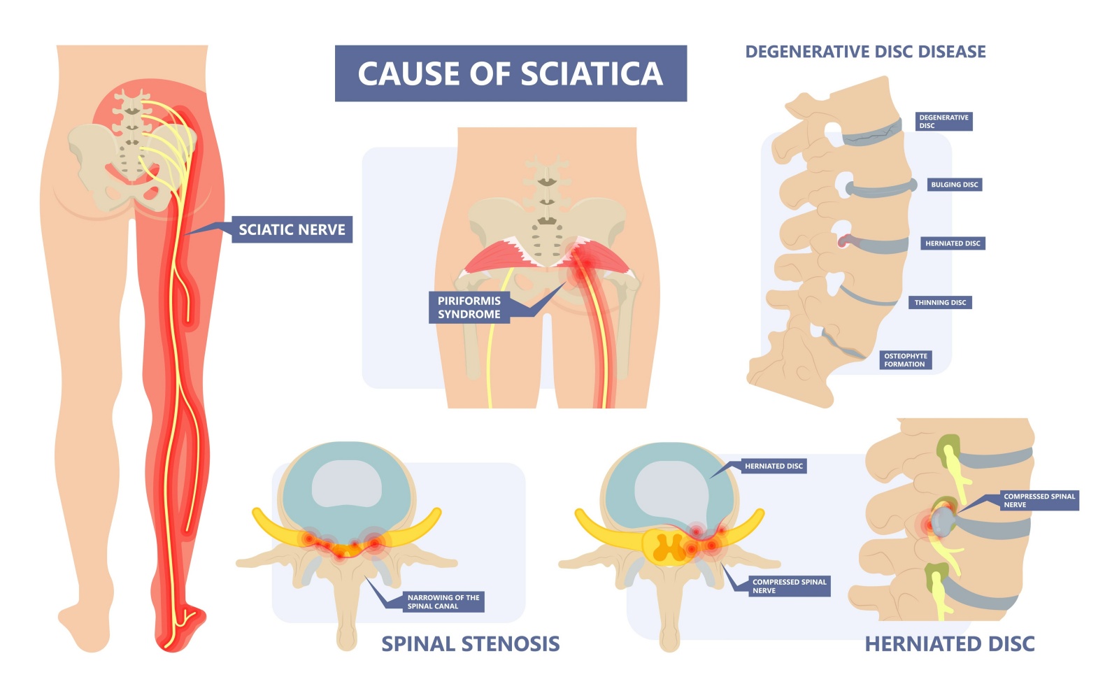 Sciatica Symptoms, Diagnosis, and Treatments - Blog