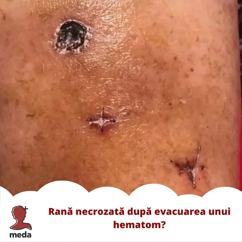 Tratarea ranilor - Tratamente la domiciliu - Pansamente - Cum tratam o rana necrozata dupa evacuarea unui hematom ?