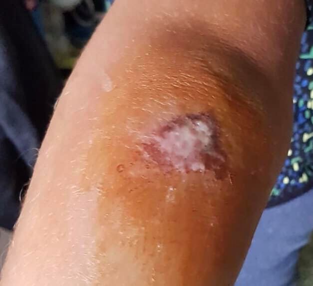 Tratamente la domiciliu - Pansamente - Tratarea ranilor 👉 un caz frecvent de julitura la copii