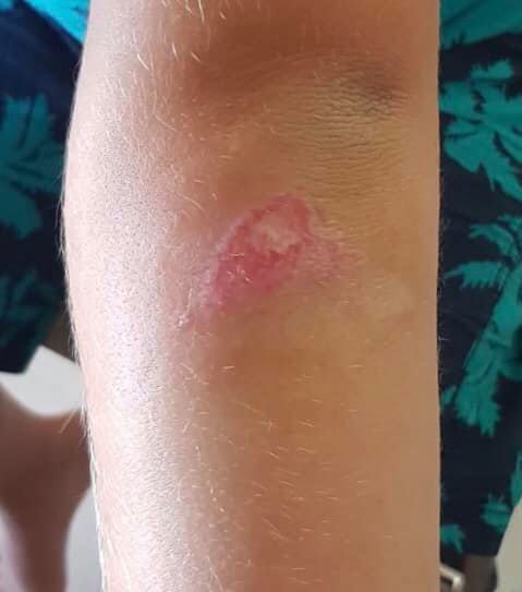 Tratamente la domiciliu - Pansamente - Tratarea ranilor 👉 un caz frecvent de julitura la copii