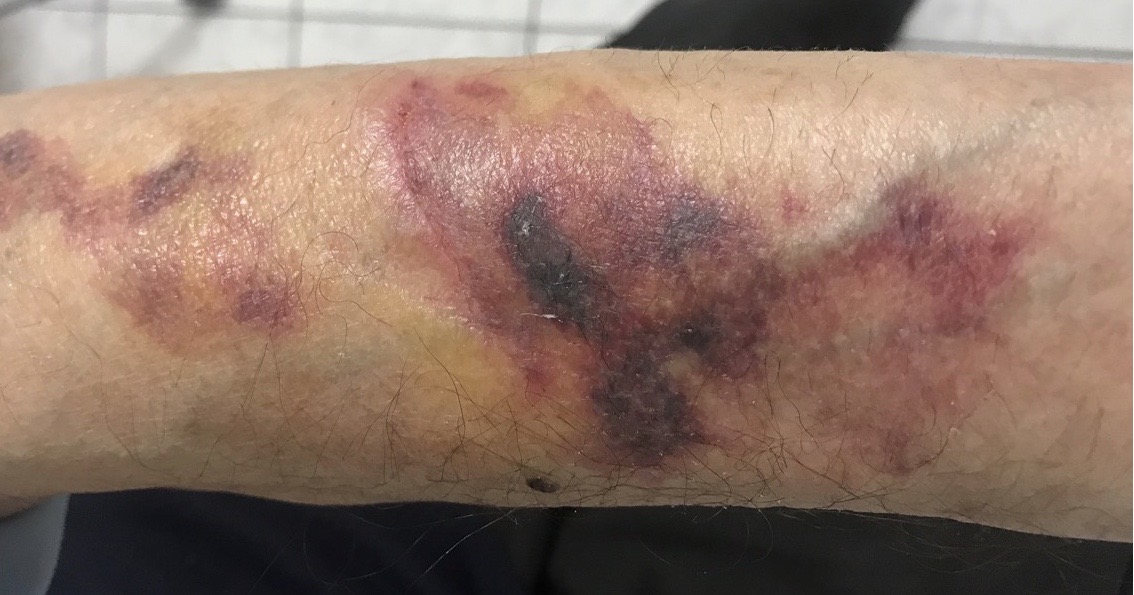 Tratarea ranilor - Tratamente la domiciliu - Pansamente - Leziune produsa prin 👉 accidentare cu un corp de mobilier