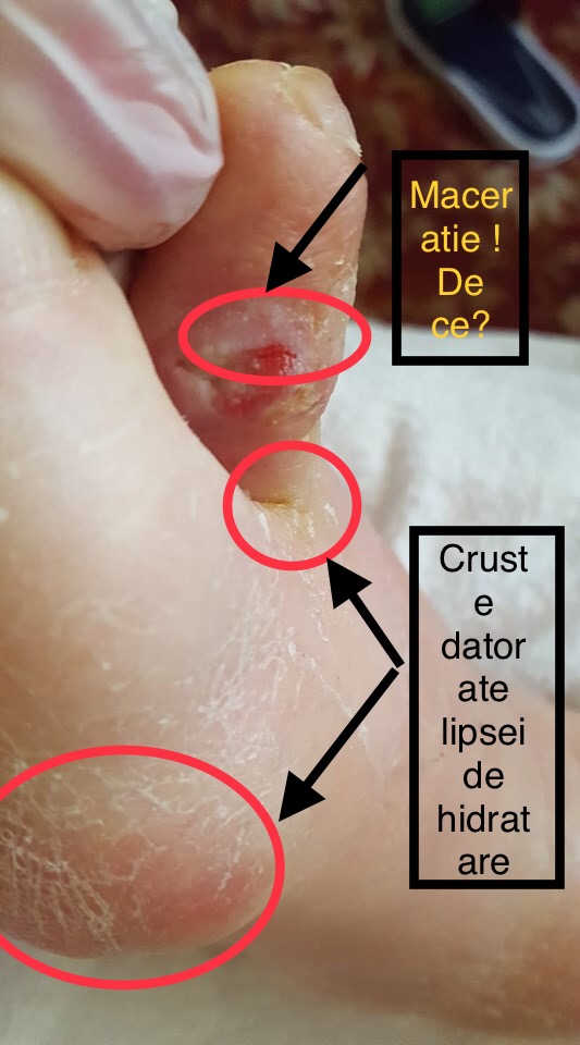 Tratamente la domiciliu - Pansamente - Tratarea ranilor  👉 Cum tratez o leziune interdigitala?