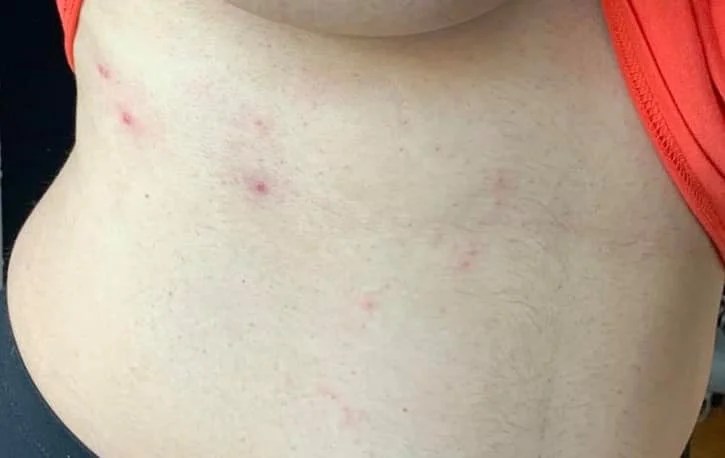 Tratamente la domiciliu - Subiecte medicale - Care este conduita si tratamentul in 👉 Zona Zoster ?