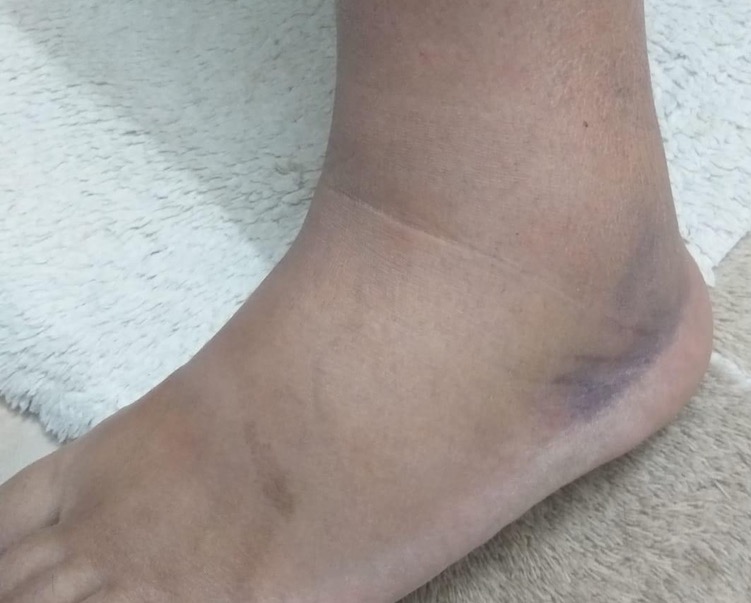 Tratamente la domiciliu - Subiecte medicale - De ce apar edemele 👉 UNILATERAL la membrele inferioare?