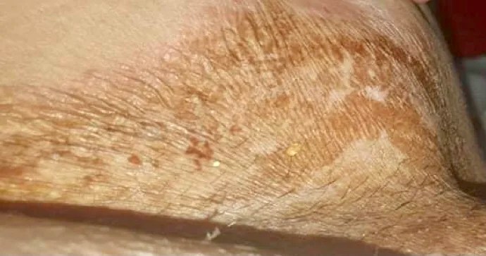 Tratamente la domiciliu - Subiecte medicale - Materiale activitate - Tratarea ranilor - Se poate face igiena intima la varstnici cu solutii de iod?