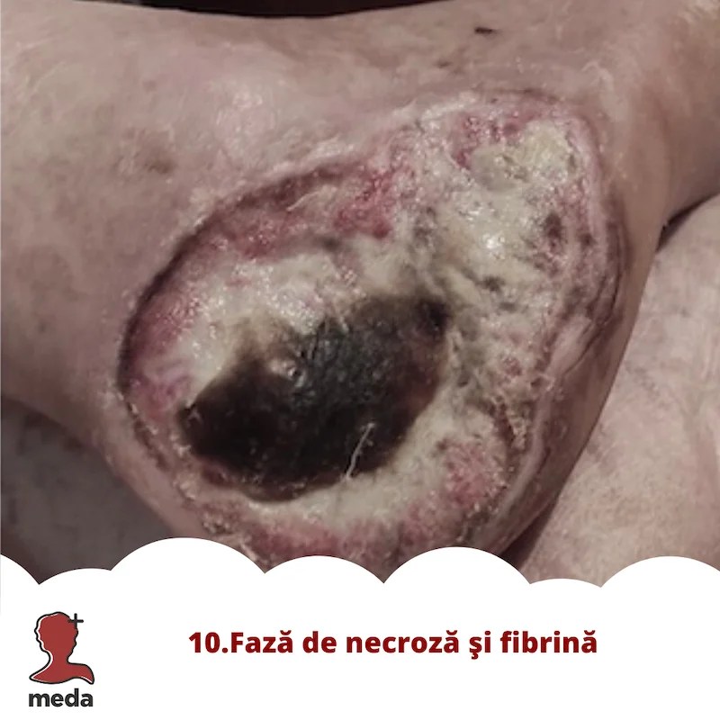 Cu ce se vindeca escarele 👉 tratarea ranilor ACASA  