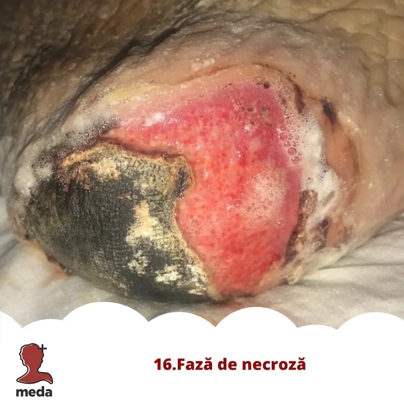 Cu ce se vindeca escarele 👉 tratarea ranilor ACASA  