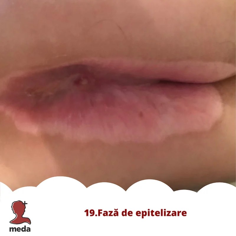 Cu ce se vindeca escarele 👉 tratarea ranilor ACASA  