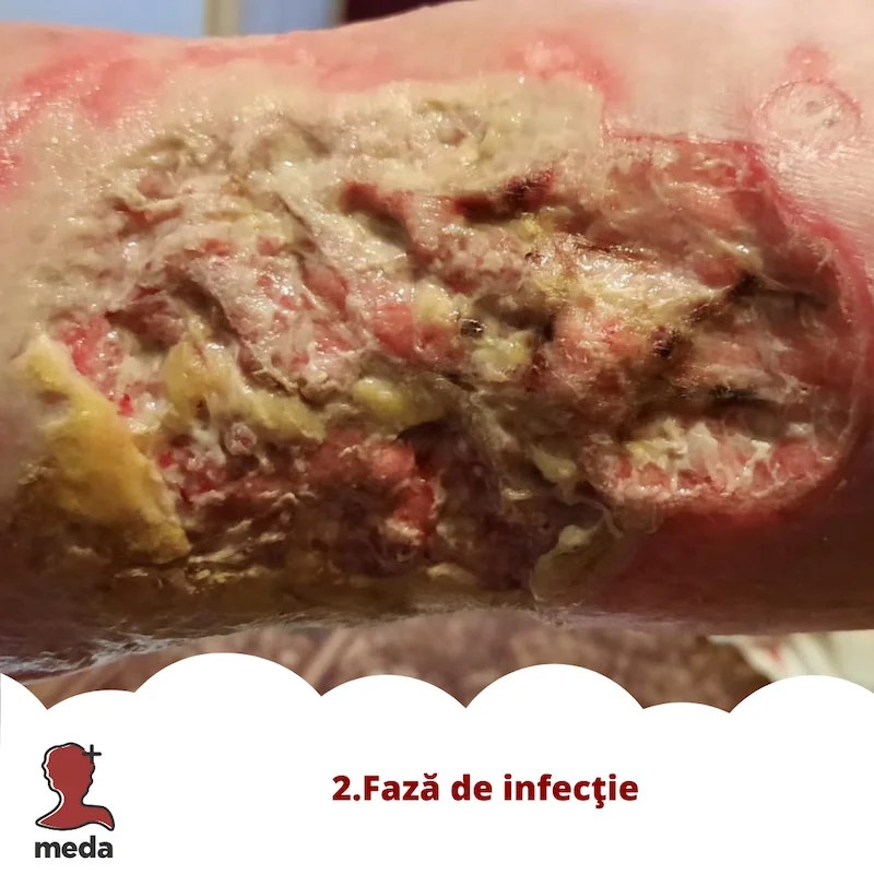 Cu ce se vindeca escarele 👉 tratarea ranilor ACASA  